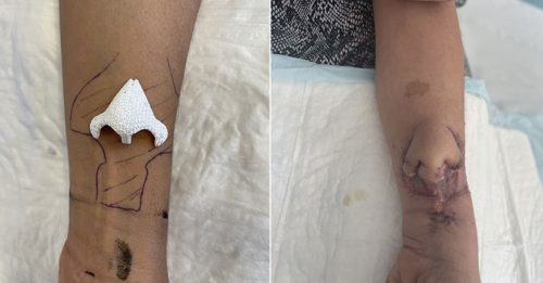 女子患癌毁容 3D打印 手臂“种”新鼻