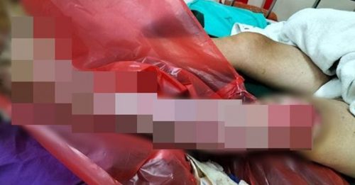 泰国旅行疑遭蝎子咬伤 男子左腿感染食肉菌