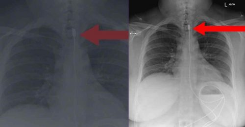呼吸困难急入院　 X光一照：1公尺充电线卡喉咙食道