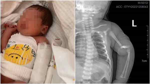 出生仅1天的男婴，在医院内被发现手臂骨折。