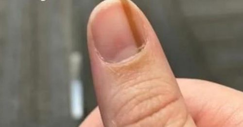 女子指甲有“啡色直线” 10年后方知患极罕见癌症