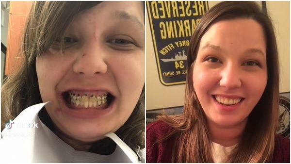 玛丽莎整排牙齿蛀烂发黑，牙龈也出现问题，右图为治疗后的情况。