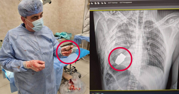 乌克兰军医采用传统手术方式，取出受伤士兵胸口的未爆炸的榴弹。