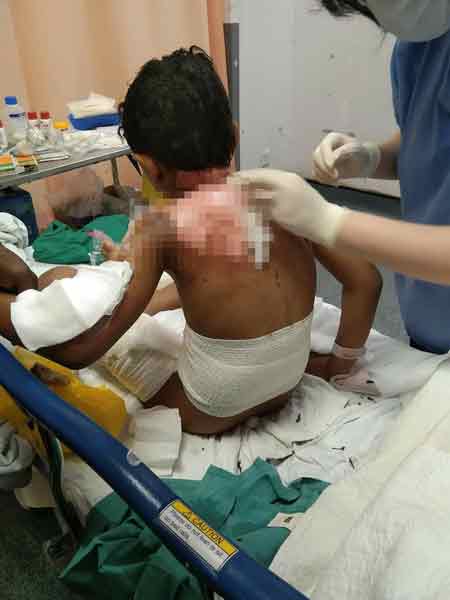 男童的伤势属于三级灼伤，虽然情况稳定，惟他将继续留院接受治疗和观察。
