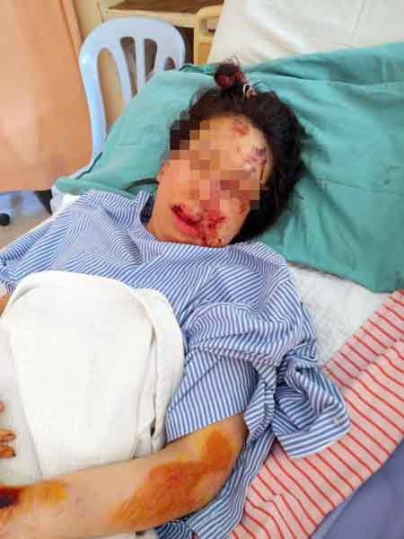 杨小姐脸部多处受伤，入院数天仍未能出院。
