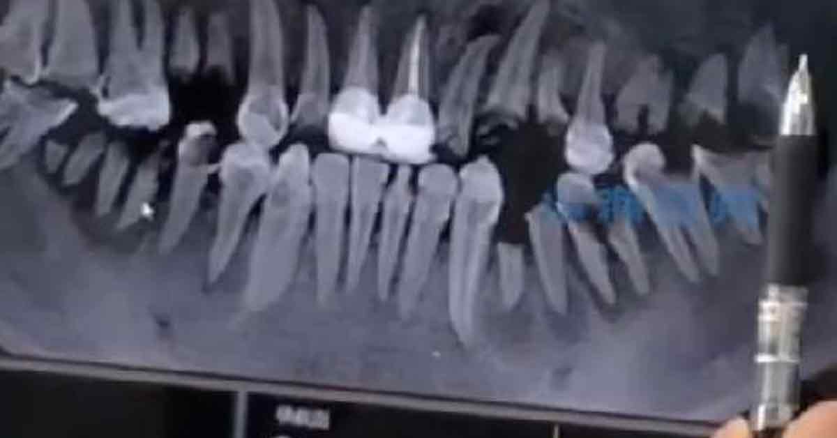 X光照片显示，男子后方牙齿几乎烂光。
