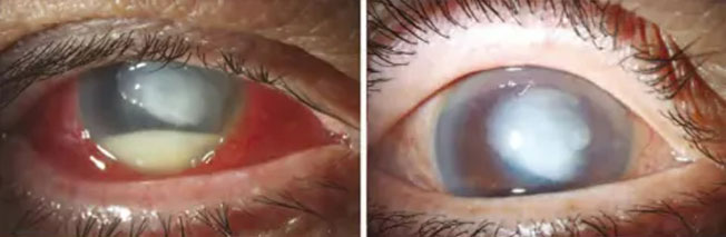 72岁老翁左眼球严重感染情况。