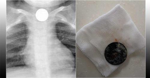 3歲童氣喘2個月 送院發現硬幣卡食道