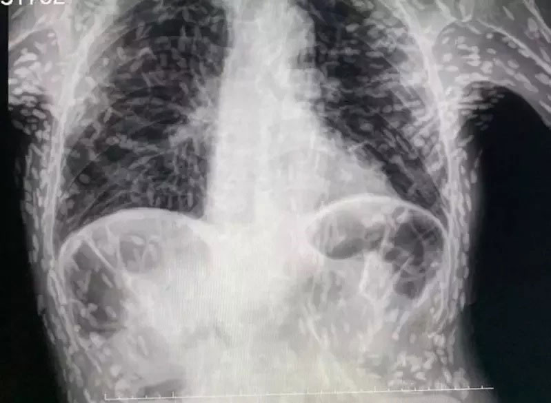 医生德索萨上传X光片，病人身上长满绦虫钙化死去后留下的囊肿。