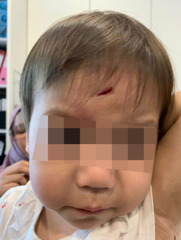 女童的额头中央留下近3公分的伤口。