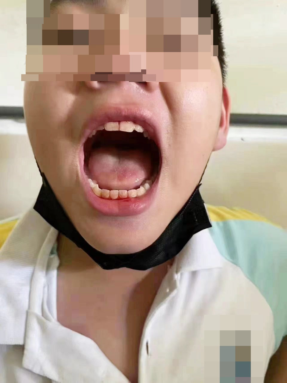 被打学生展示嘴部伤势。