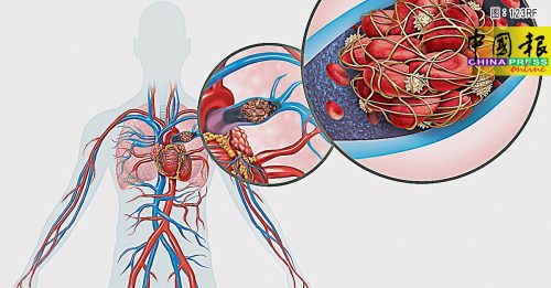 ◤健康百科◢记得做好这4点 防肺栓塞找上门