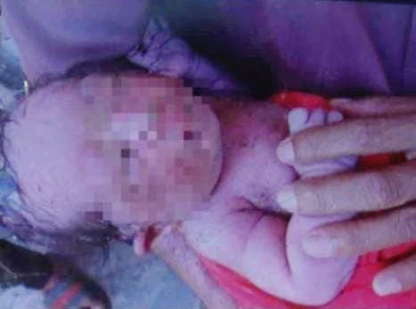 女婴被发现时全身赤裸，脐带已剪断，已送往医院，接受治疗。