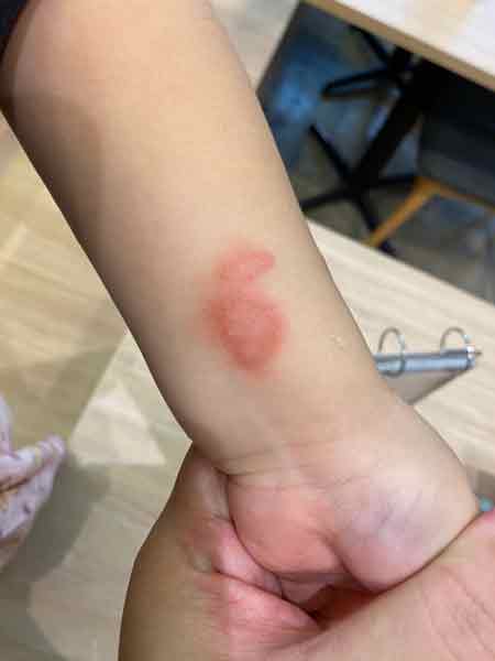 妇女女儿的的腋窝处及手腕同样被隐翅虫咬伤，导致皮肤被灼伤。