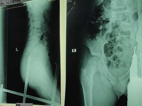 boy hurt 篱笆 屁股