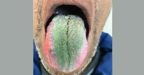 舌头长“诡异绿毛” 竟是“这原因”所致