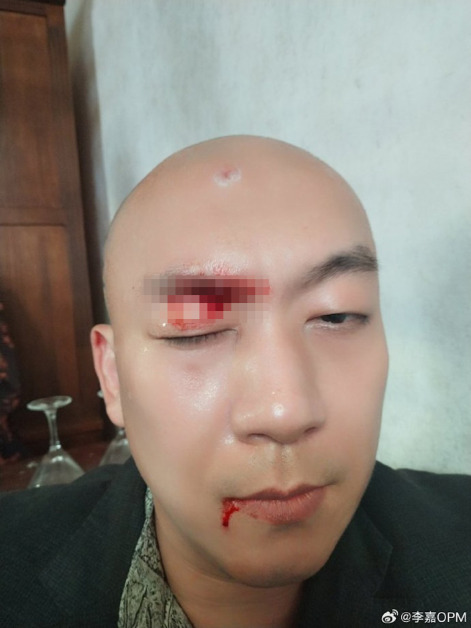李嘉整个眼角都是血。(图/微博)