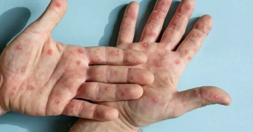 泰猴痘疫情升温 8月增145病例