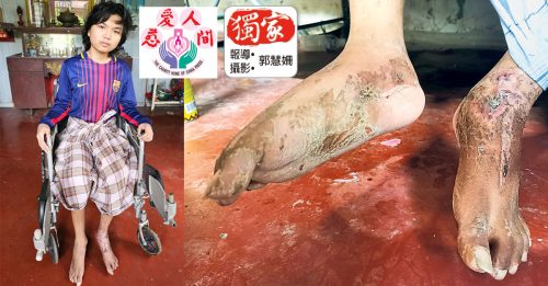 ◆獨家◆摔斷腳行動不便生活陷困 17歲華裔少年 無錢複診【內附音頻】