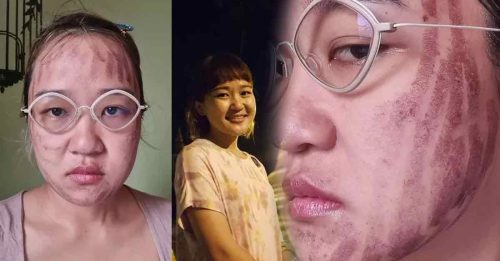 雷射美容除青春痘 女子全脸灼伤毁容