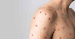 一个月增5猴痘病例 患者皆是男性
