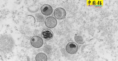 日本首宗猴痘死亡病例  患者染HIV免疫力低下