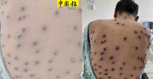 都是男性  中国11月新增80例猴痘病例