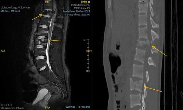 术前CT示胸腰椎多发爆裂性骨折伴移位