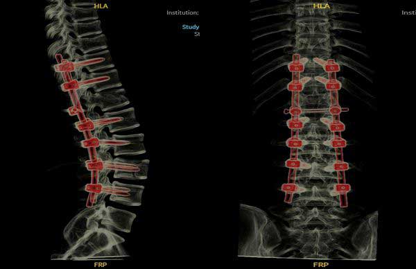 术后CT示椎体内固定位置稳定，骨折端对位、对线好