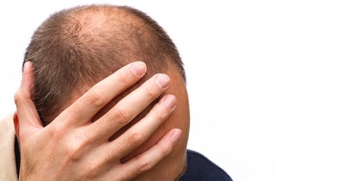 全球男性秃头率排名 西班牙最高 大马第44