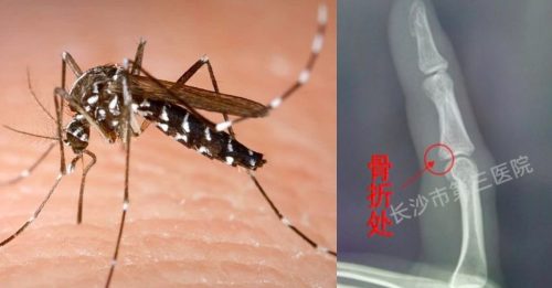 啪！女子一巴掌 蚊子没打到 手却骨折了