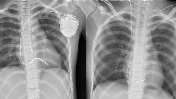 小六女童听到闹钟半夜尖叫、痉挛,状态持续2年,为罹患罕见心脏病。