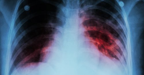 去年通报2.6万结核病例 夺2580人性命