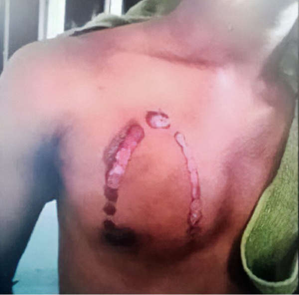 阿米鲁被控于10月22日，使用热蒸汽熨斗蓄意致伤20岁的莫哈末沙曼，后者胸部的烫伤痕极为明显。