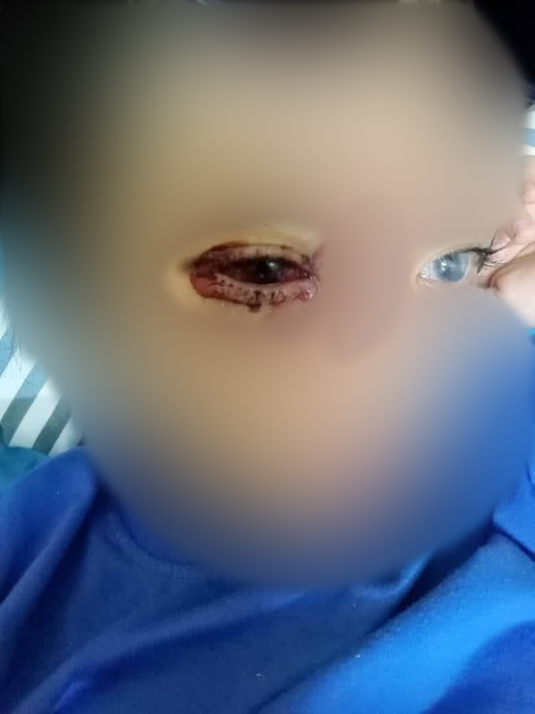 小妮手术后右眼充血,视力随后不升反降。(黄美琪提供)