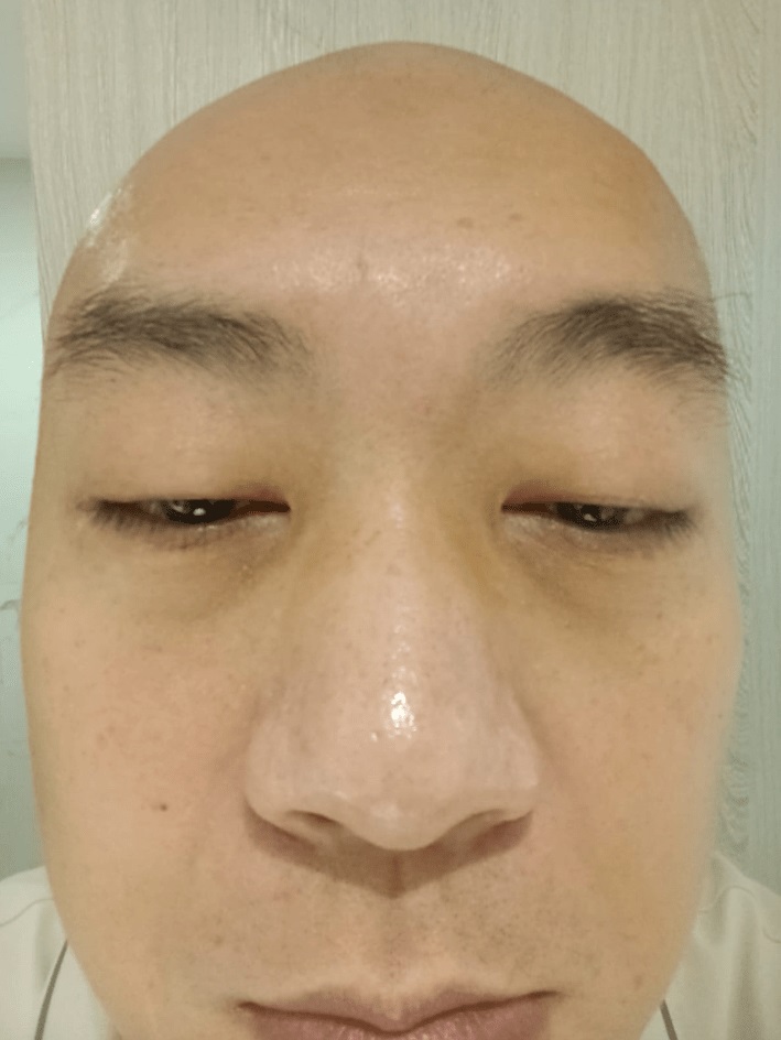 李嘉怀疑自己误服禁药一个月。