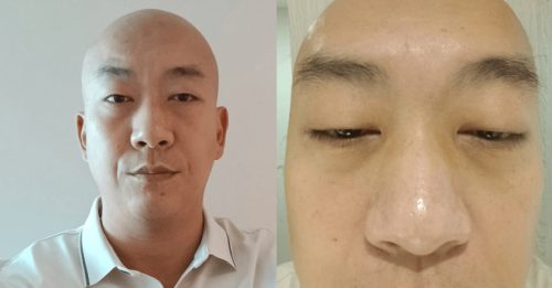 “TVB御用恶人”患过敏性结膜炎 疑误服禁药一个月险盲