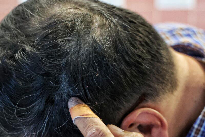 陈先生的头部缝了5针。