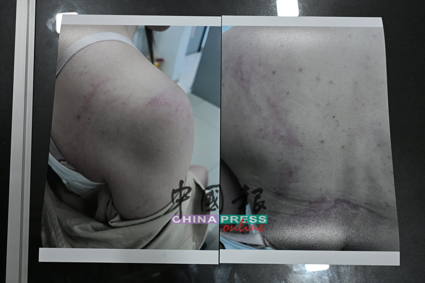 女事主的面部、手部和背部皆有明显伤痕。
