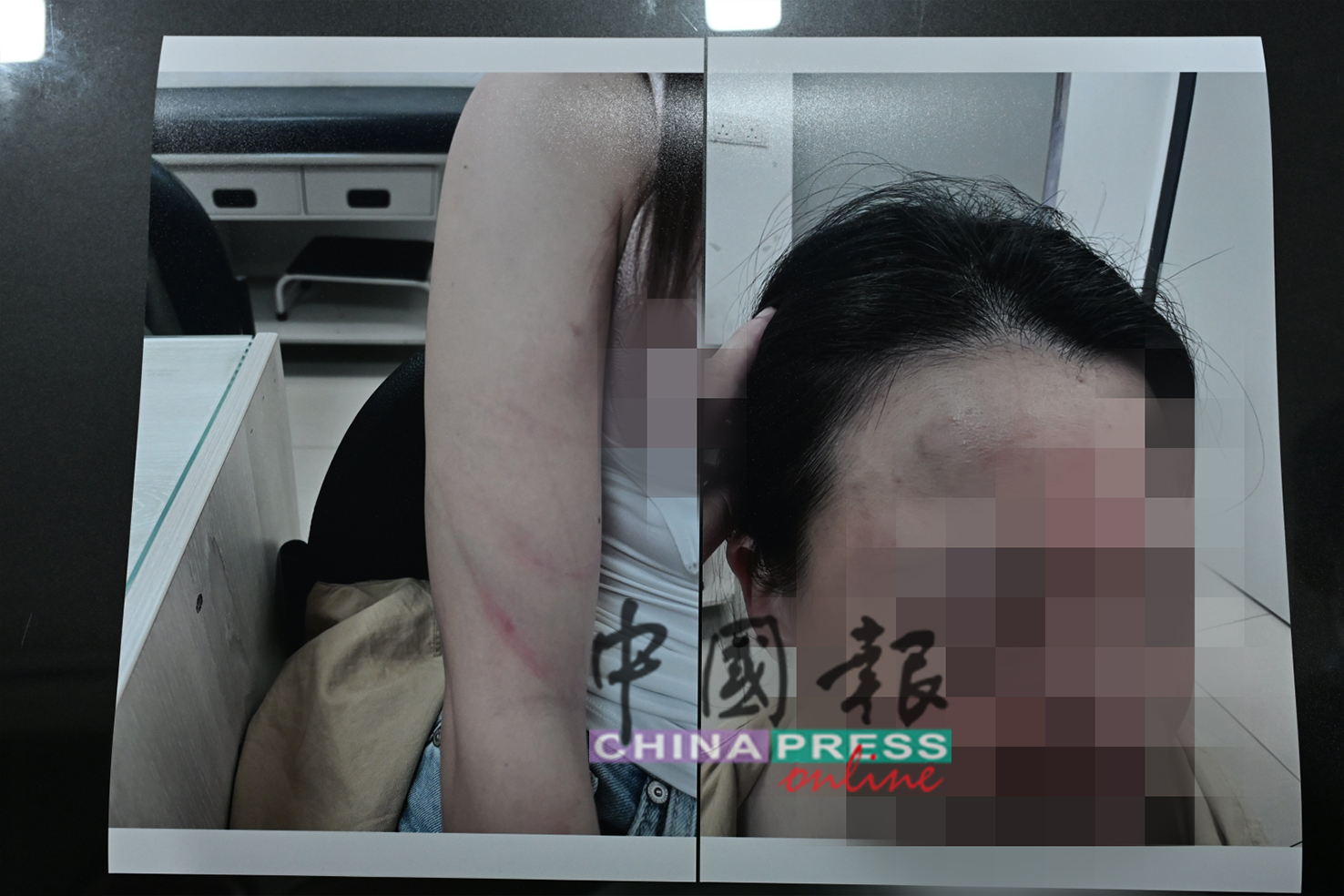 女事主的面部、手部和背部皆有明显伤痕。