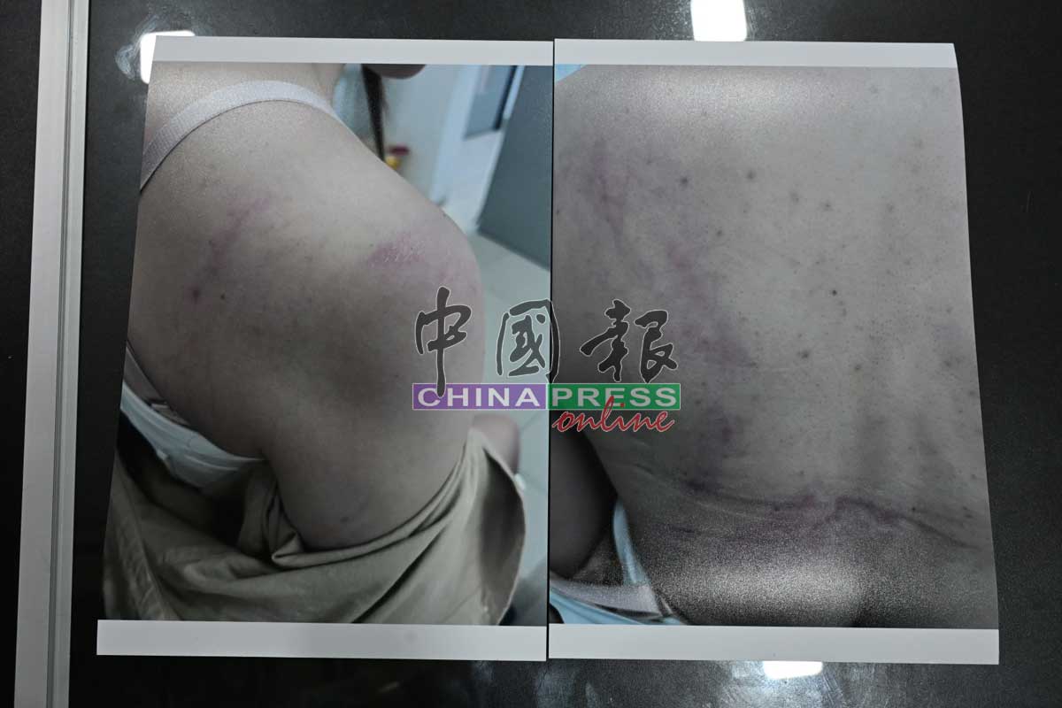 女事主控诉，由于长期被丈夫家暴，造成她全身几乎遍体鳞伤。