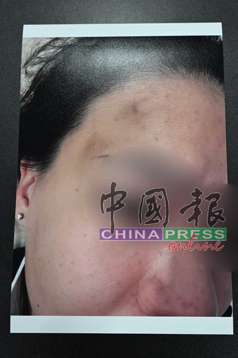 女事主控诉，由于长期被丈夫家暴，造成她全身几乎遍体鳞伤。