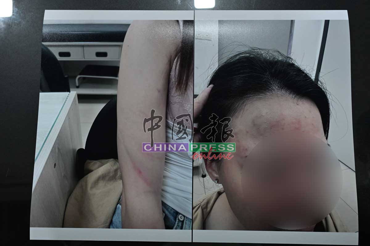 女事主控诉，由于长期被丈夫家暴，造成她全身几乎遍体鳞伤。