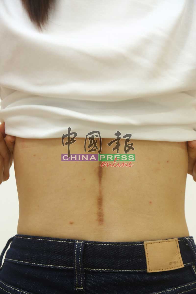 女事主向现场的女记者展示其背部的伤痕。