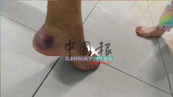 方晓芬丈夫的脚踝在搏斗中受伤。