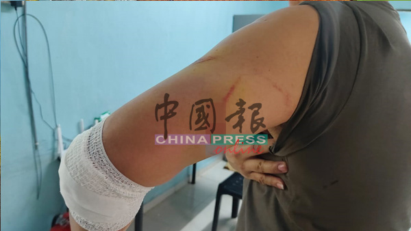 手臂遭巴冷刀砍伤。