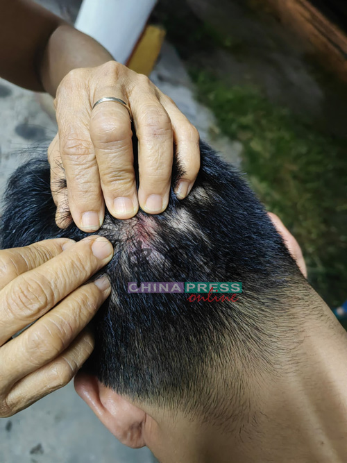 方晓芬丈夫的额头遭恶徒敲击