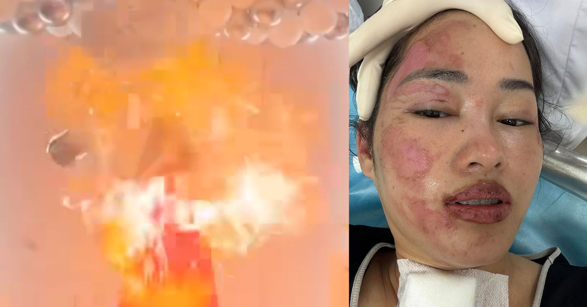 派对 氢气球爆炸 女子生日 惨破相｜附音频