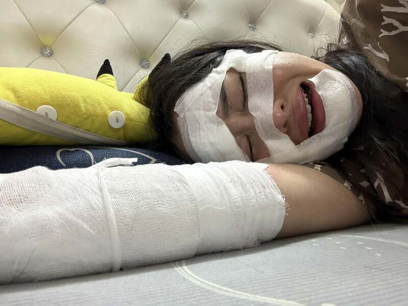 派对 氢气球爆炸 女子生日 惨破相｜附音频