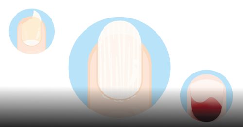 健康百科｜指甲异常敲响健康警钟